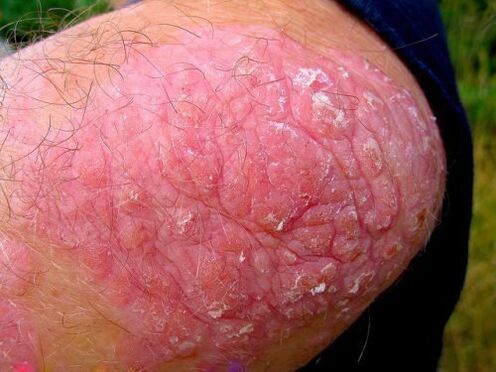 psoriasis vulgaris on the knee