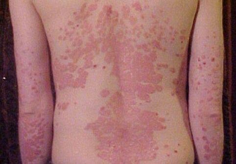 symptoms of psoriasis in the back