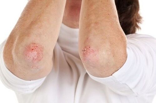 Manifestations of psoriasis on the elbow