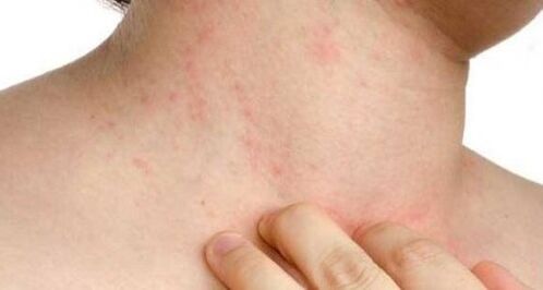itching of the skin in the early stages of psoriasis