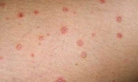 manifestations of the early stages of psoriasis on the skin