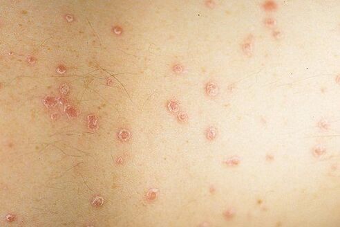 pictures of the early stages of psoriasis