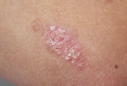 psoriatic plaques on the skin