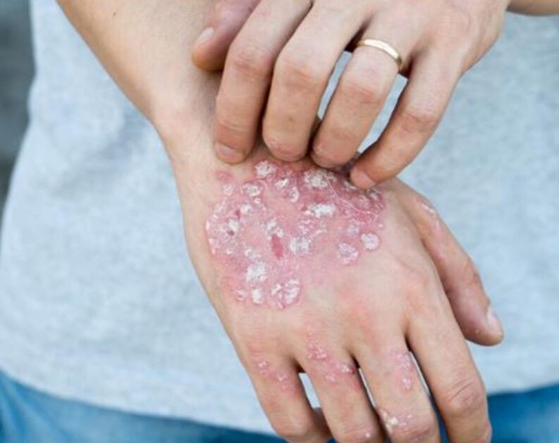 psoriasis on a man's hand