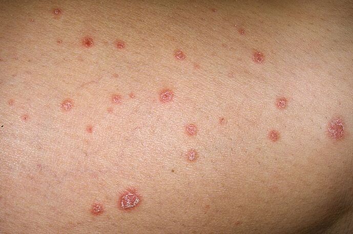 picture the first symptoms of psoriasis