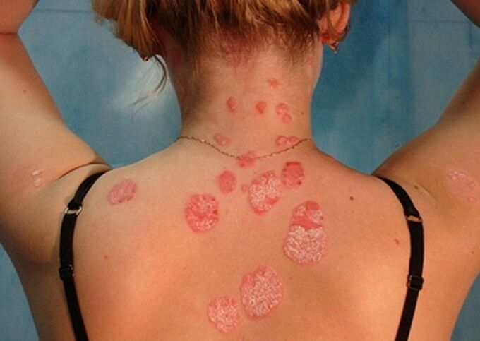 psoriasis of the neck and back