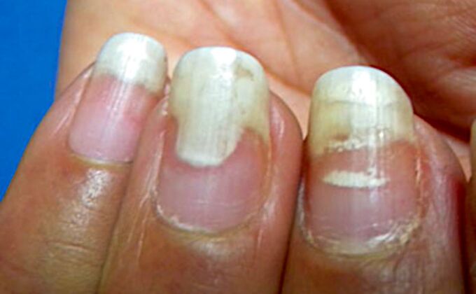 Onycholysis and leukonychia after manicure