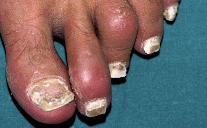 Psoriasis with nail involvement and arthritis of the toes