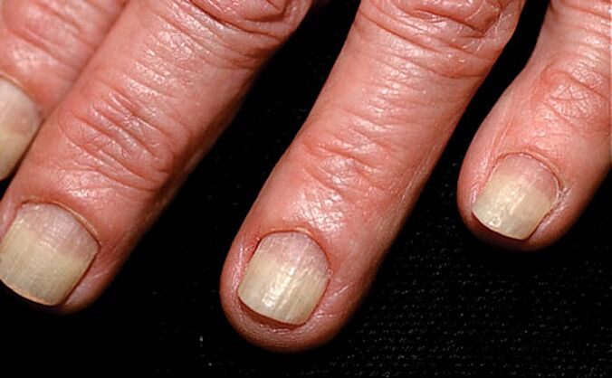 The spread of onycholysis from the edges of the nail to the folds of the nail