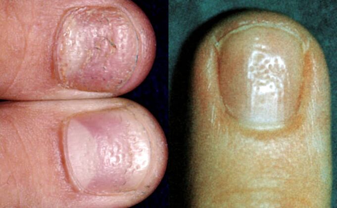 Thimble symptoms - a lot of depression on the surface of the nail plate