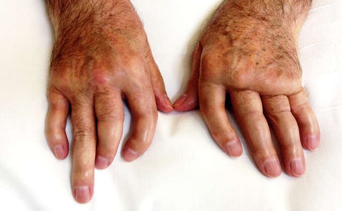 Whitening arthritis in psoriasis