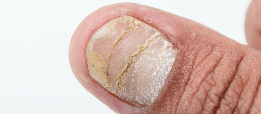 acute complication forms of psoriasis on the nails
