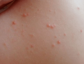 showing symptoms of rash psoriasis