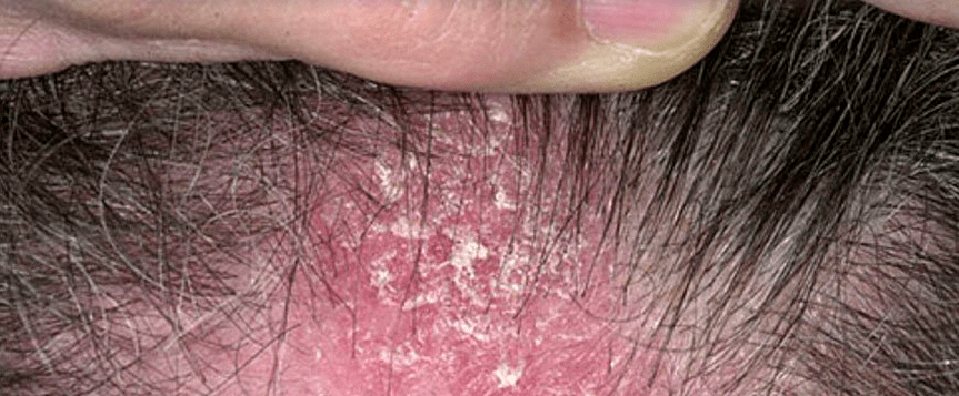 skin lesions on the scalp with psoriasis