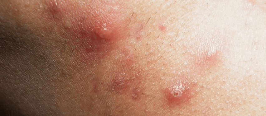 the onset of development of guttate psoriasis in childhood