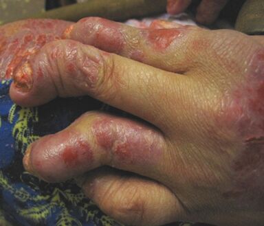 Neglected psoriasis on the hands
