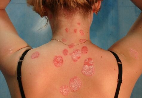 psoriasis on the back