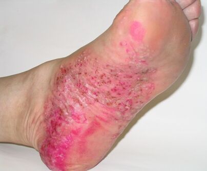 psoriasis on the feet